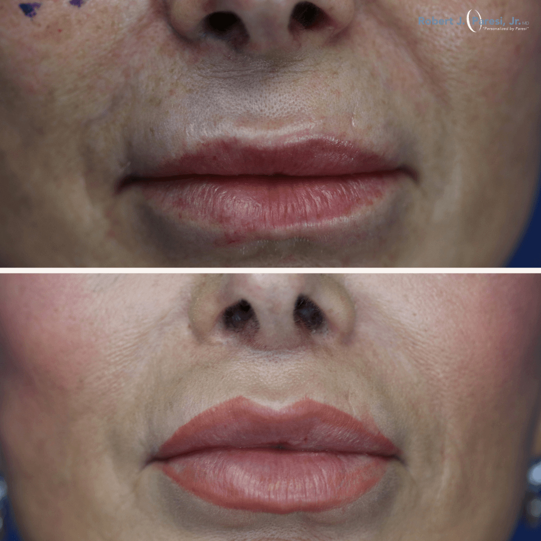 Lip Lift